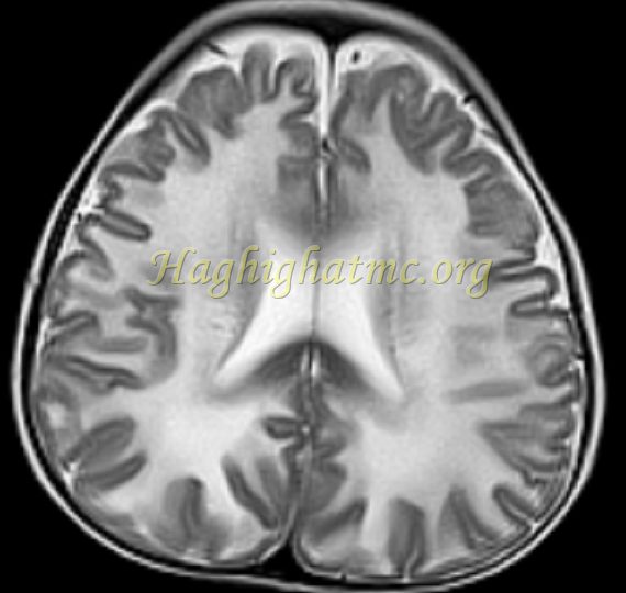 Ped neuro1 d