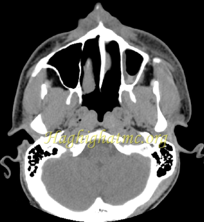 Xray1
