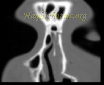 Xray5