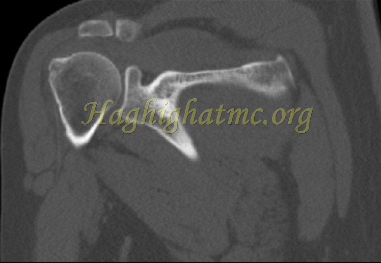 Xray6