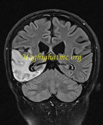 infective-3.jpg