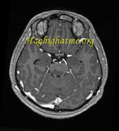 infective-case2-5.jpg