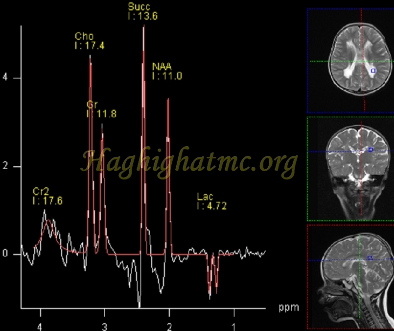 ped neuro6 d