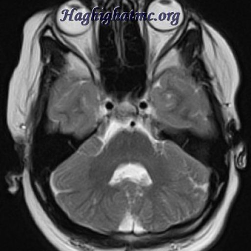 TSR Watermark - 312
